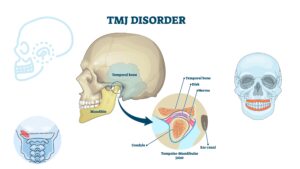 A Comprehensive Guide to Fixing Temporomandibular Joint (TMJ) Disorder